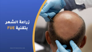 زراعة الشعر بالاقتطاف تقنية FUE