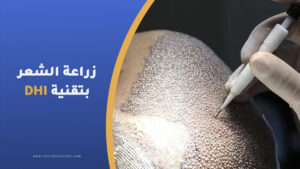 التقنيات المستخدمة في عملية زراعة الشعر