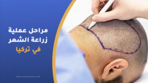 مراحل عملية زراعة الشعر في تركيا