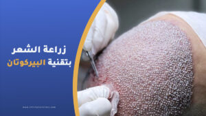 تقنية البيركوتان لزراعة الشعر