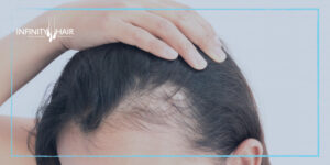 حقن البلازما للشعر PRP