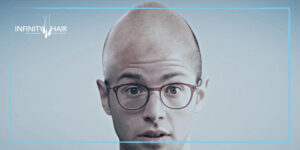 زراعة الشعر للرجال في تركيا