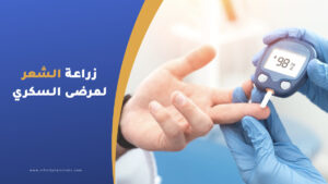 زراعة الشعر لمرضى السكري