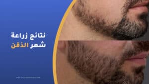 نتائج زراعة شعر الذقن