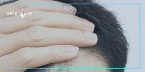 زراعة الشعر الصناعي الايطالي في تركيا