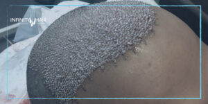 زراعة الشعر بتقنية الاقتطاف الدقيق NANO-FUE.001