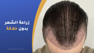 زراعة الشعر بدون حلاقة