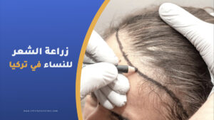 زراعة الشعر للنساء في تركيا
