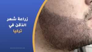 زراعة شعر الذقن في تركيا