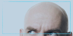 أسباب الصلع عند الرجال