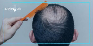 أفضل تقنية لزراعة الشعر