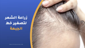 زراعة الشعر لتصغير خط الجبهة