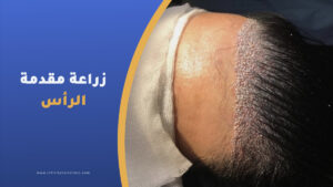 زراعة مقدمة الرأس للنساء
