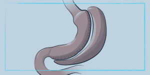 عملية تصغير المعدة في تركيا