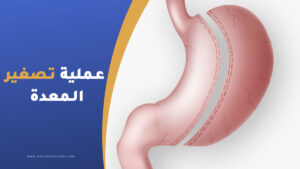عملية تصغير المعدة في تركيا