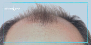 عملية زراعة الشعر في تركيا