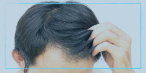 كيف تتم عملية زراعة الشعر