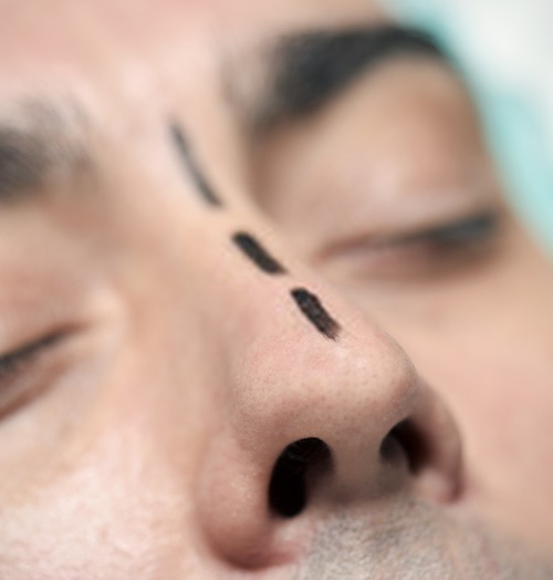 فوائد إجراء عملية تجميل الأنف
