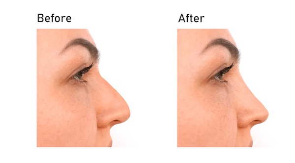 نتائج عملية تجميل الانف في تركيا