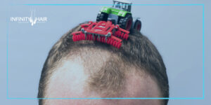 علاج تساقط الشعر في تركيا