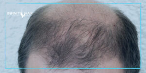 علاج تساقط الشعر للرجال الوراثي