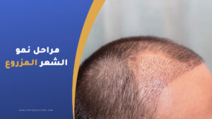 مراحل نمو الشعر المزروع | بعد زراعة الشعر وحتى اكتمال النمو