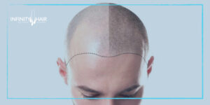 نصائح قبل زراعة الشعر في تركيا