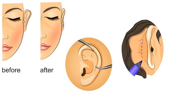 كيف تتم عملية تجميل الأذن