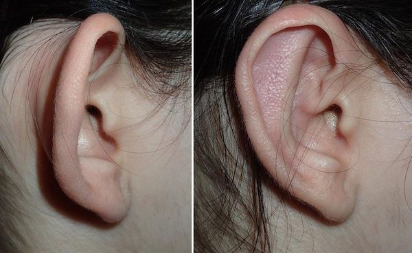 نتائح عملية تجميل الأذن في تركيا