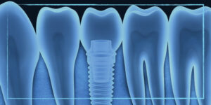 زراعة الأسنان في إسطنبول