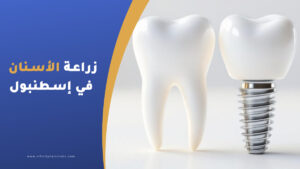 زراعة الأسنان في إسطنبول