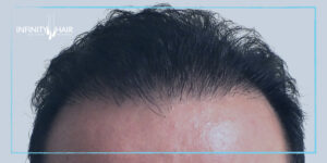 زراعة الشعر الطبيعي في تركيا.