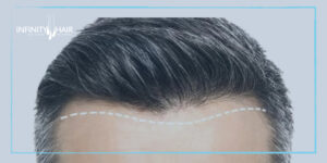 زراعة الشعر بدون جراحة | الفرق بينها وبين الطريقة الجراحية