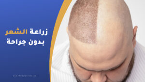 زراعة الشعر بدون جراحة | الفرق بينها وبين الطريقة الجراحية