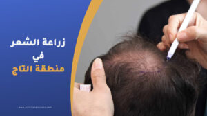 زراعة منطقة التاج - قمة الرأس