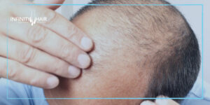 معلومات عن زراعة الشعر