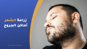 زراعة الشعر في أماكن الجروح و الحروق