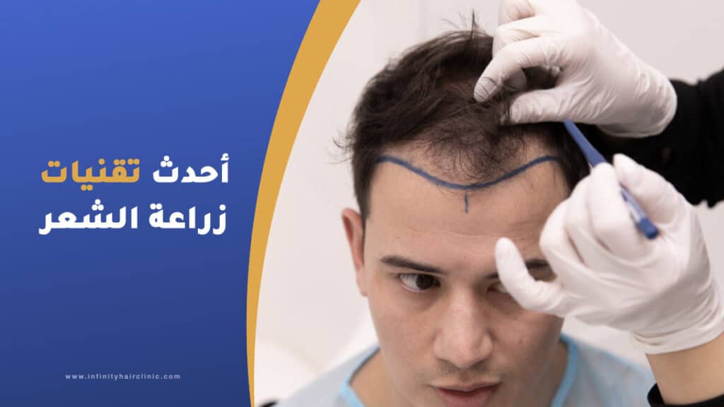 أحدث تقنيات زراعة الشعر