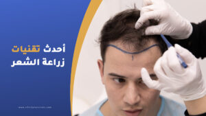 أحدث تقنيات زراعة الشعر