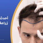 أحدث تقنيات زراعة الشعر