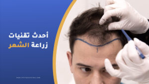 أحدث تقنيات زراعة الشعر