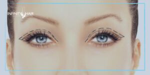 عملية شد الجفون في تركيا