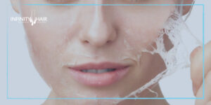 التقشير الكيميائي في تركيا