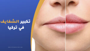تكبير الشفايف في تركيا