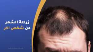 زراعة الشعر من شخص اخر