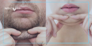 شفط دهون الذقن