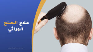 علاج الصلع الوراثي عند الرجال