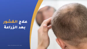علاج القشور بعد زراعة الشعر