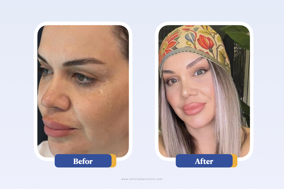 نتائج قبل وبعد عملية رفع الحاجب.