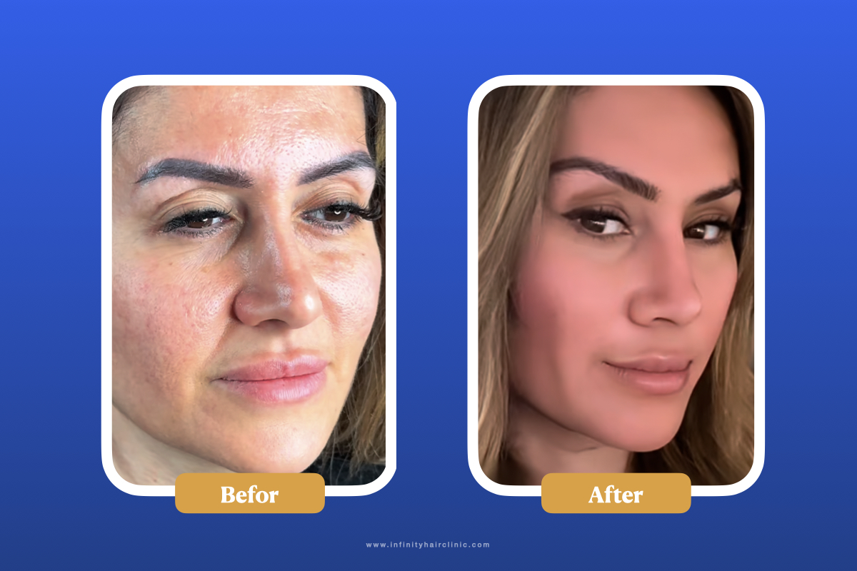 نتائج قبل وبعد عملية رفع الحاجب.